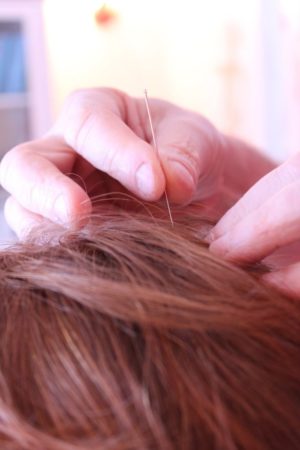 The use of acupuncture